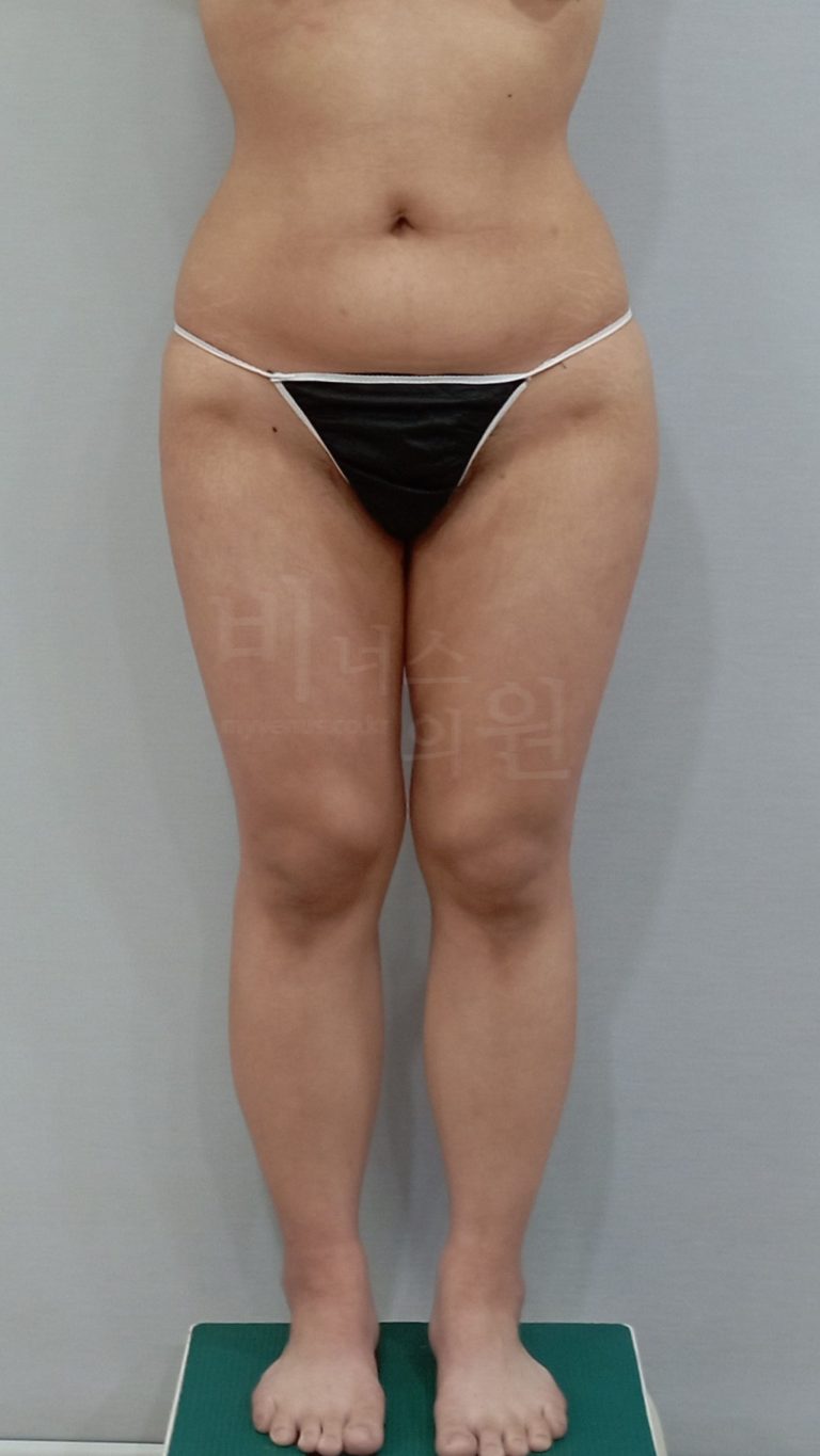 엉덩이축소 지방흡입 — 허벅지·무릎 동시 수술, 하체 전체 라인이 달라진 경험 솔직하게