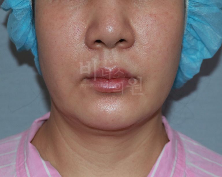 턱지방흡입 받기 전에 알았으면 좋았을 것들 — 국소마취·회복·기대치까지 솔직 정리