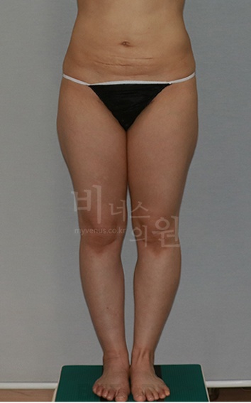 허벅지 지방흡입 회복 후기 — 수술 당일부터 한 달, 경화부터 운동 재개까지 솔직하게