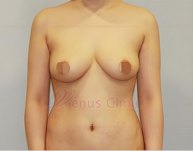 가슴축소 지방흡입 비용, 어떻게 결정될까? 절개 수술 vs 지방흡입 — 선택 기준 완전 정리