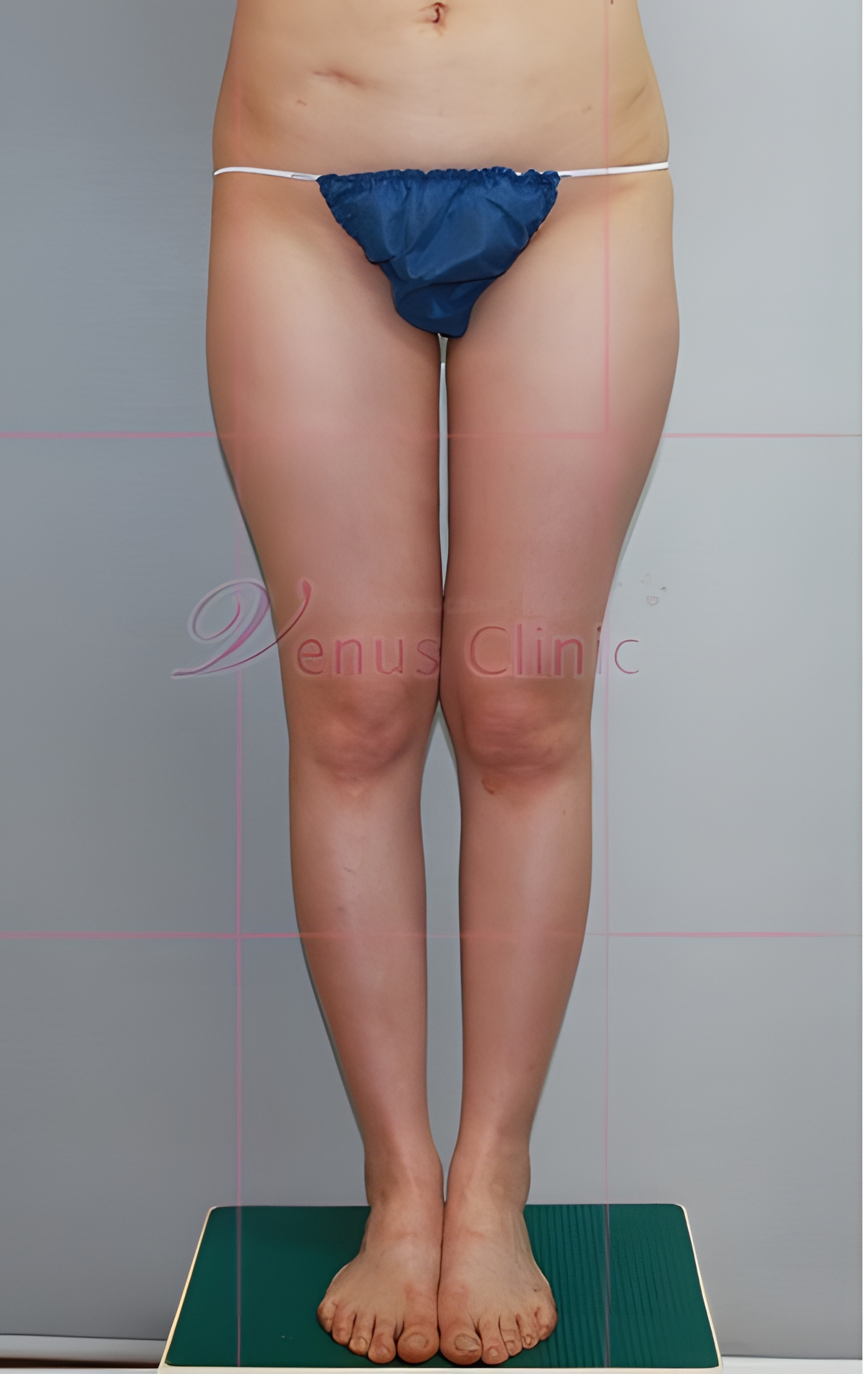 엉덩이 볼륨업 지방흡입 수술 전 정면 — 볼륨 없는 납작한 힙 라인