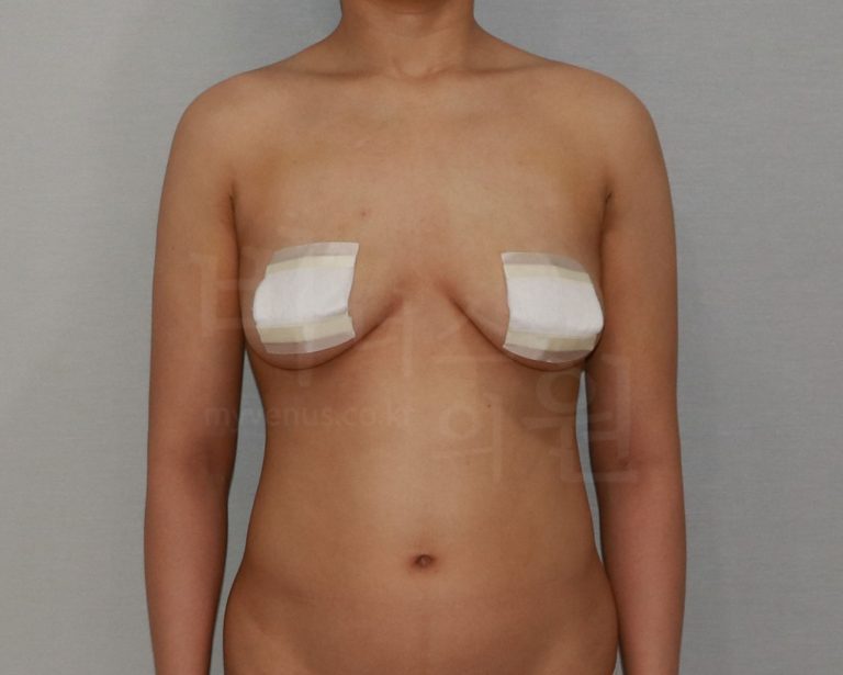 팔뚝지방흡입 후기 — 수술 전 불안에서 한 달 후 달라진 일상까지