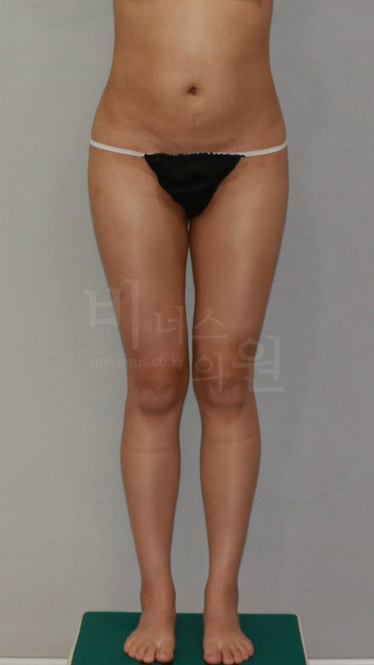 엉덩이 볼륨업 지방흡입 회복 후기 — 수술 당일부터 한 달까지 솔직하게