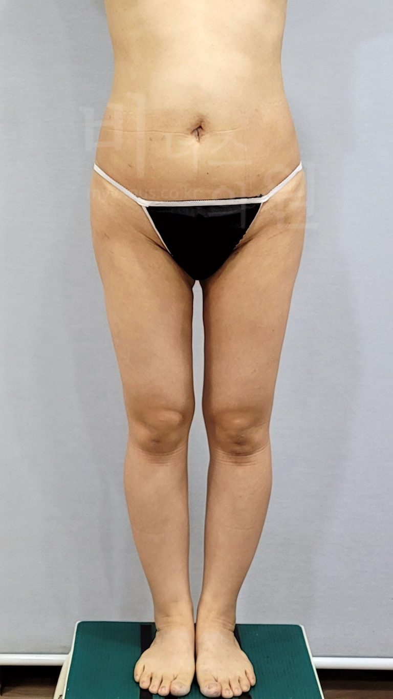 엉덩이 지방흡입 전후사진 — 허벅지 동시 수술로 뒷태가 달라진 회복 과정 기록