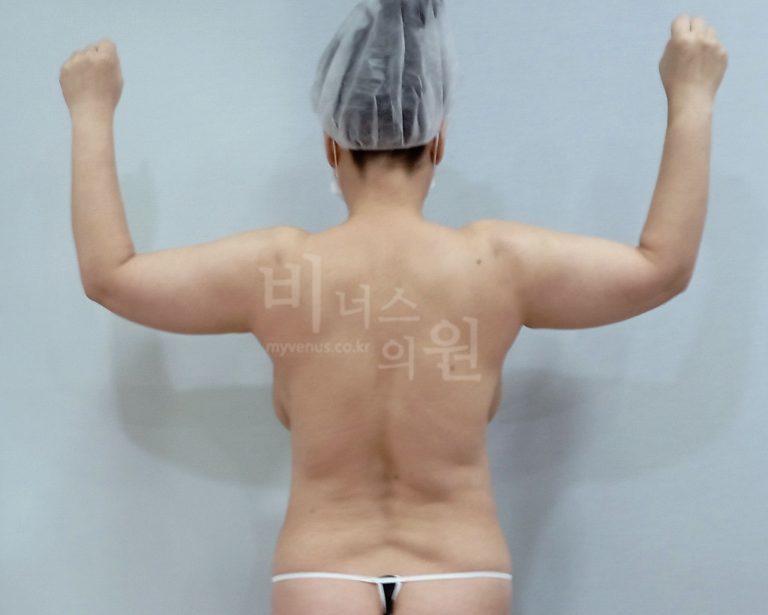 팔뚝살, 운동해도 안 빠지는 이유 — 지방흡입 결심하기까지