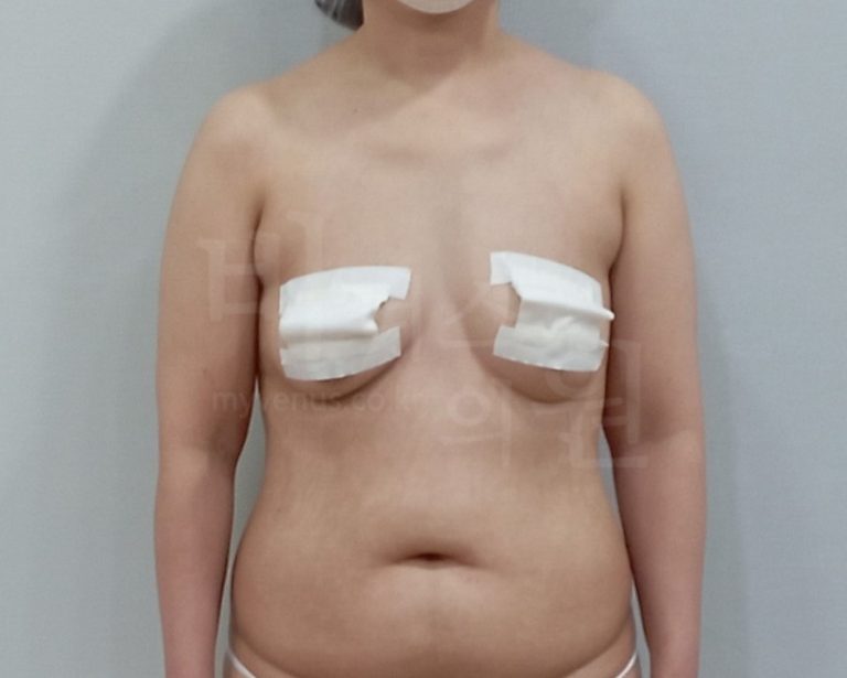 팔뚝 지방흡입 후 회복 과정 — 수술 당일부터 한 달까지의 변화를 알아보세요