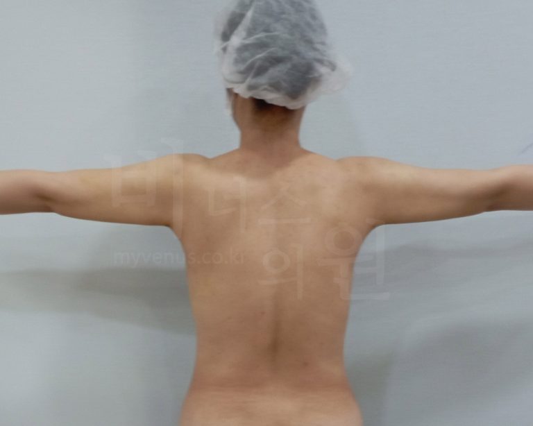 팔뚝지방흡입 후 경화과정·붓기·압박복 — 처음 겪어보는 회복, 이게 다 정상이에요