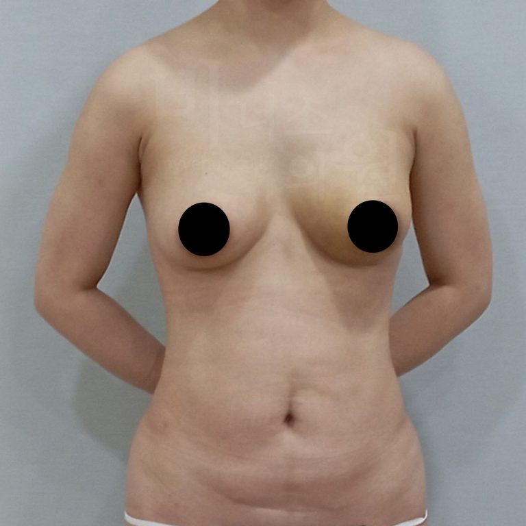 가슴이 너무 무거워 결심했어요 — 가슴축소 지방흡입 수술부터 2.5주 회복까지 솔직 경험