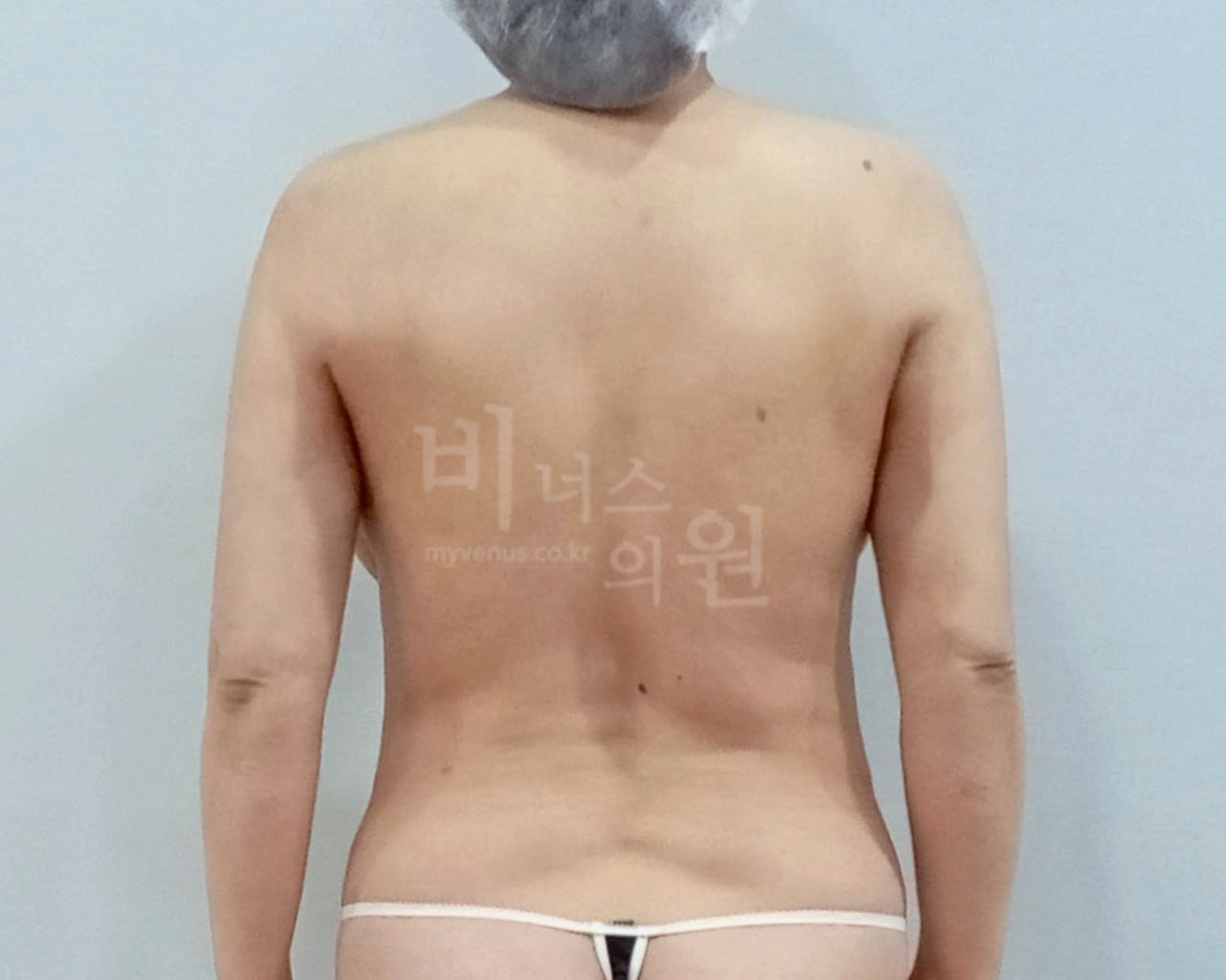 팔뚝지방흡입 차렷 자세 수술 후 — 팔뚝 후면 슬림해짐
