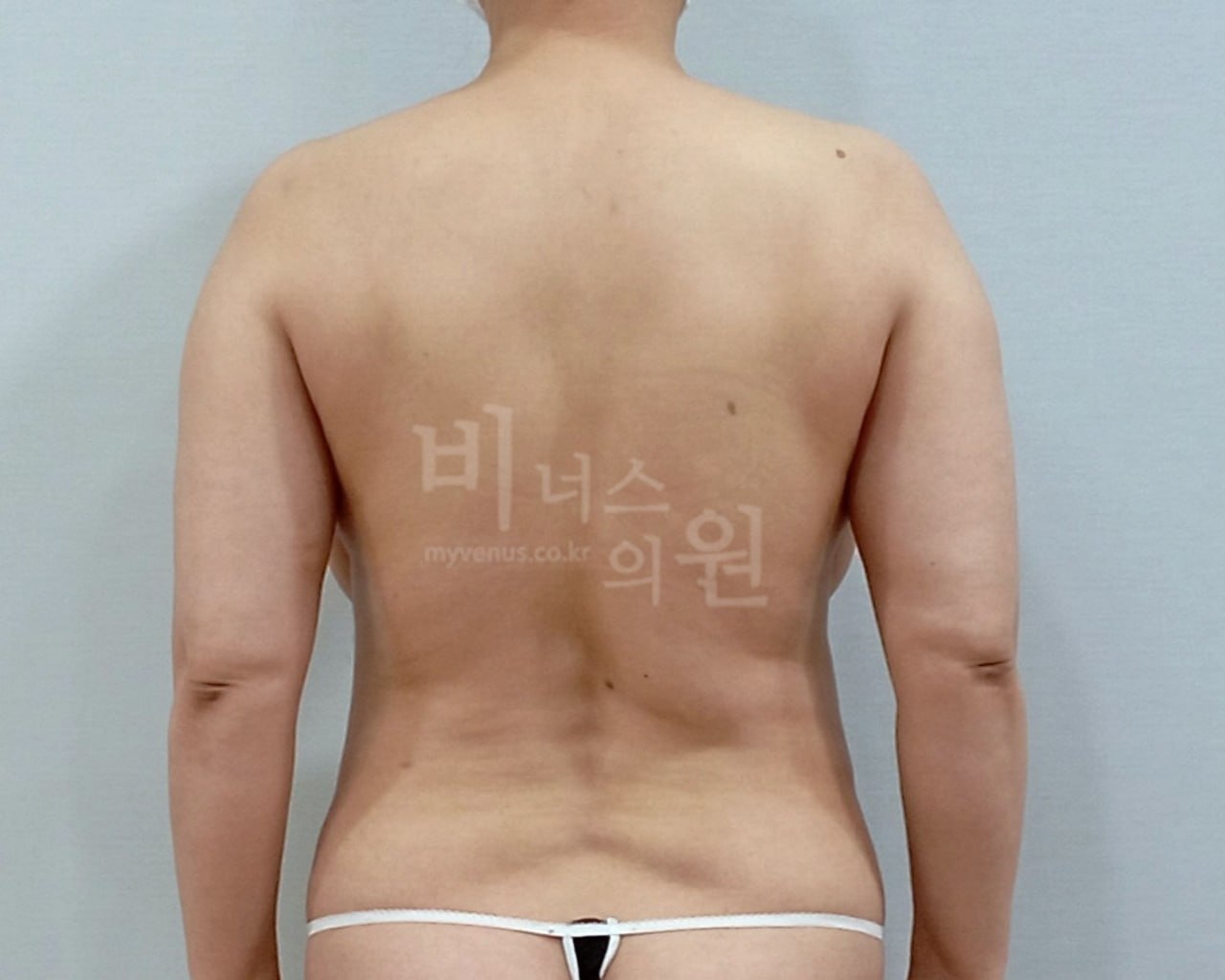 팔뚝지방흡입 차렷 자세 수술 전 — 팔뚝 후면 살 있음