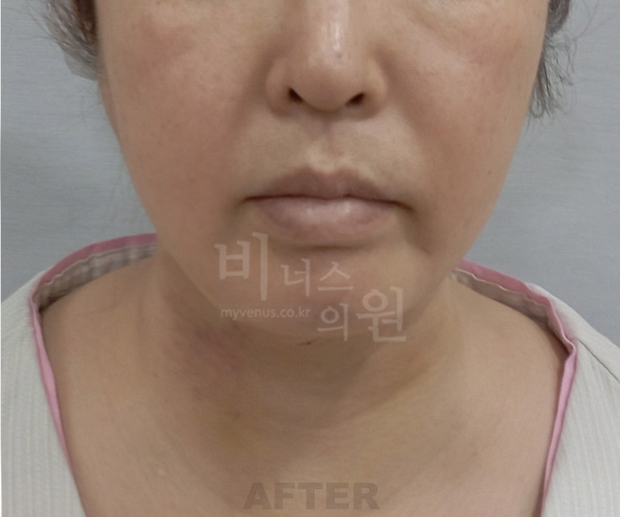 이중턱 지방흡입 수술 후 정면 — 하악선 선명화 및 턱선 개선