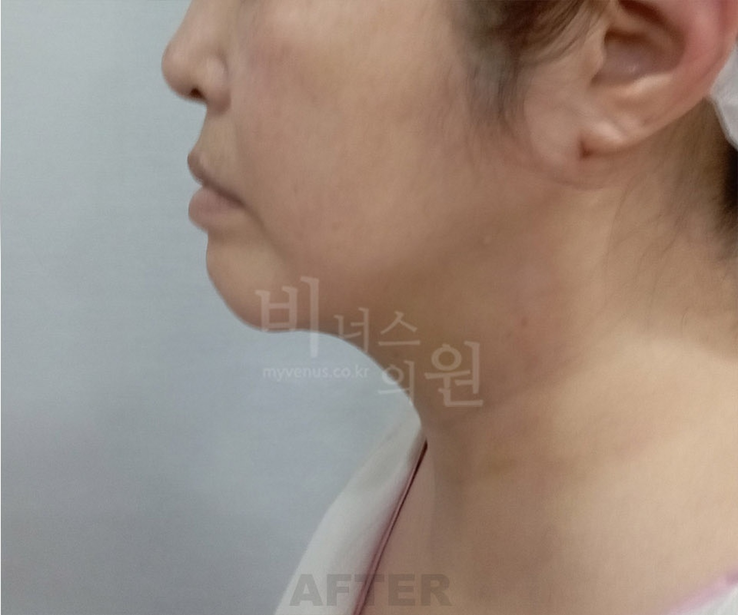 이중턱 지방흡입 수술 후 측면(우측) — 하악선 프로파일 개선