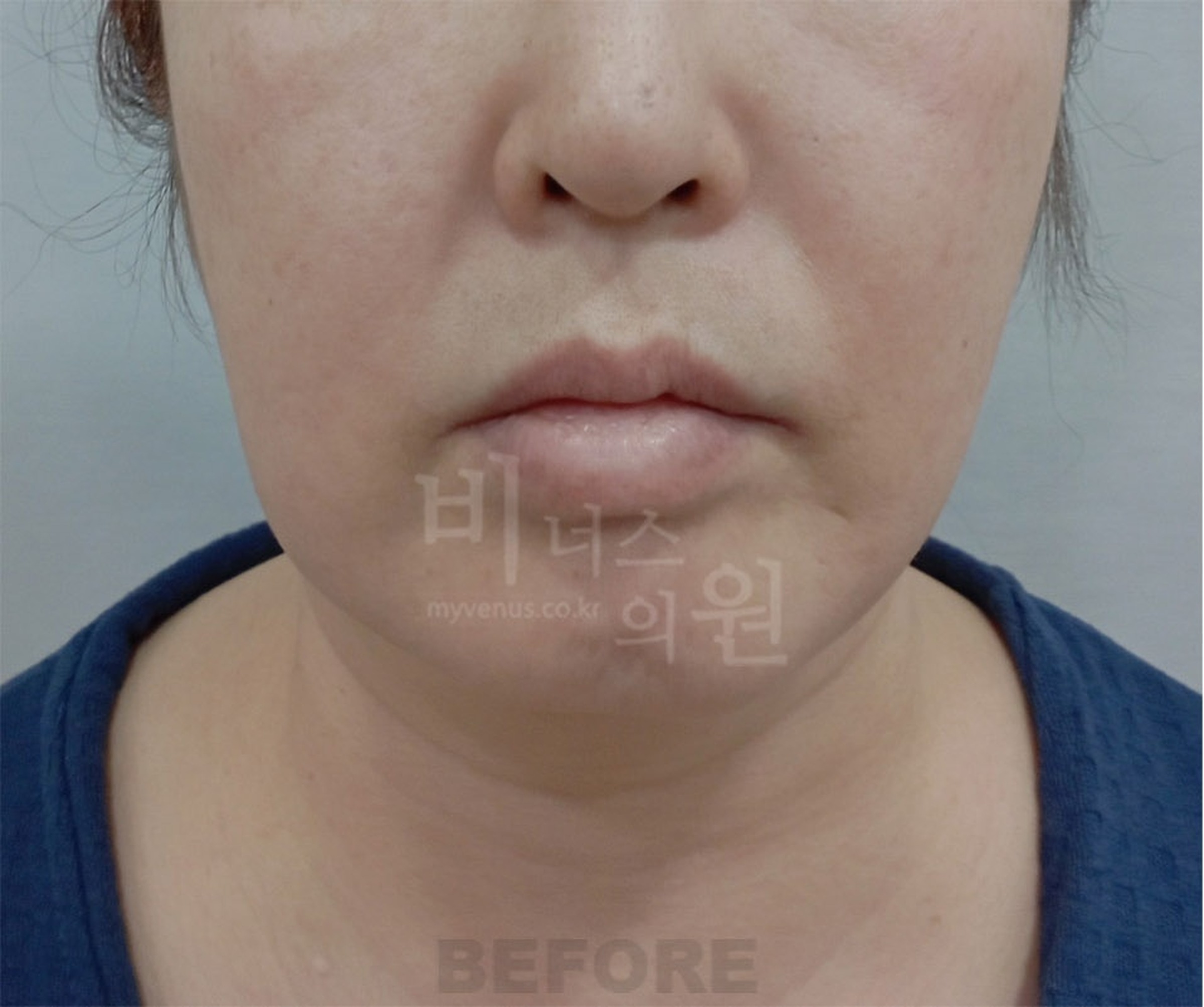 이중턱 지방흡입 수술 전 정면 — 이중턱 지방 볼륨