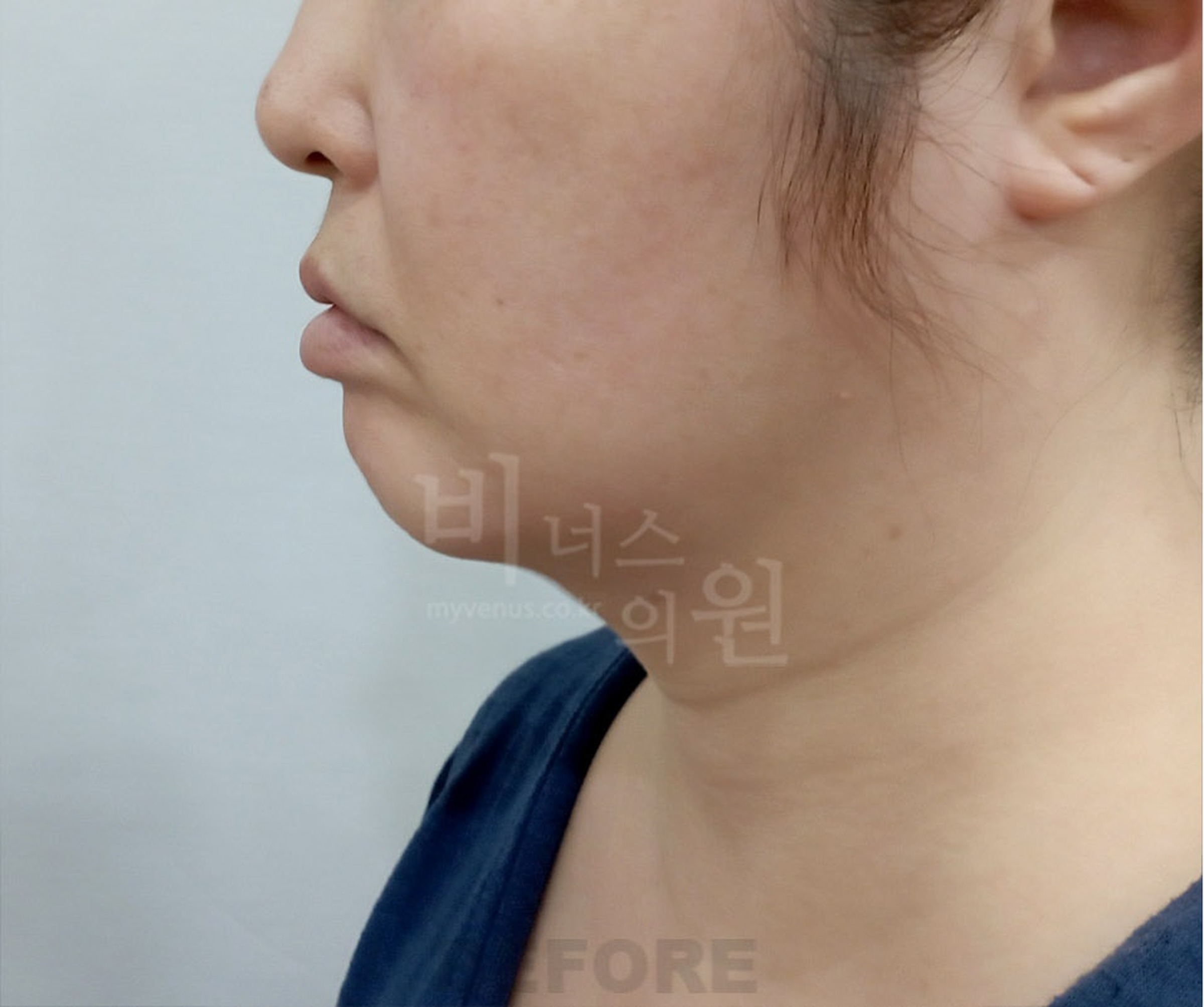 이중턱 지방흡입 수술 전 측면(우측) — 이중턱 프로파일