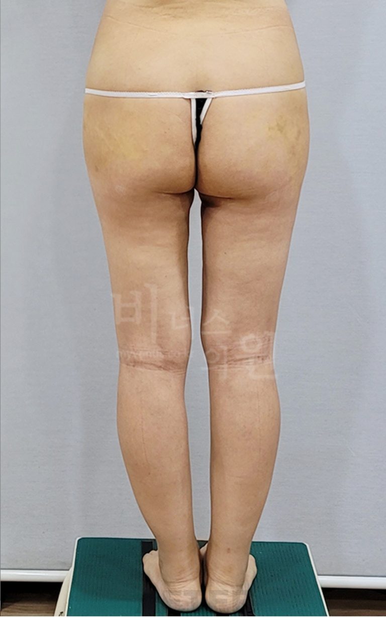 엉덩이가 커서 늘 불편했어요 — 축소 지방흡입 후 달라진 것들, 솔직하게 정리했습니다