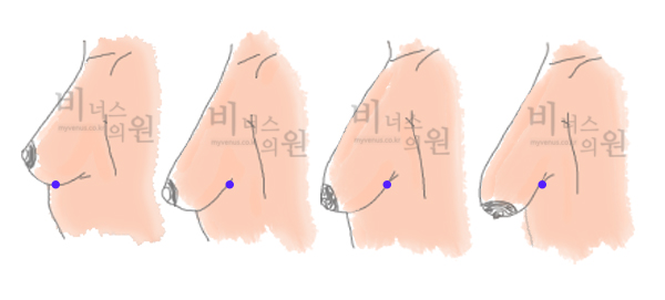 가슴축소 지방흡입 — 수술 부위 및 단계 설명 도식