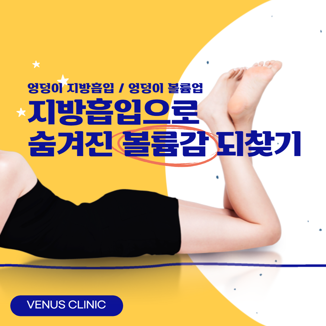 비너스의원 엉덩이성형 수술 범위 다이어그램 — 지방흡입 및 지방이식 부위 설명