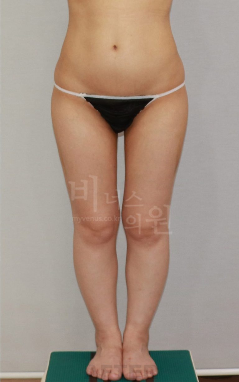엉덩이 축소 지방흡입 수술 후 회복 이야기 — 수술 당일부터 한 달까지