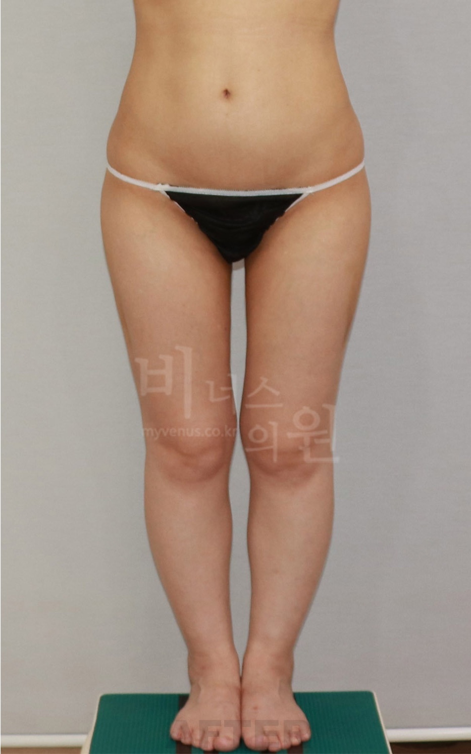 엉덩이 축소 지방흡입 수술 후 회복 이야기 — 수술 당일부터 한 달까지