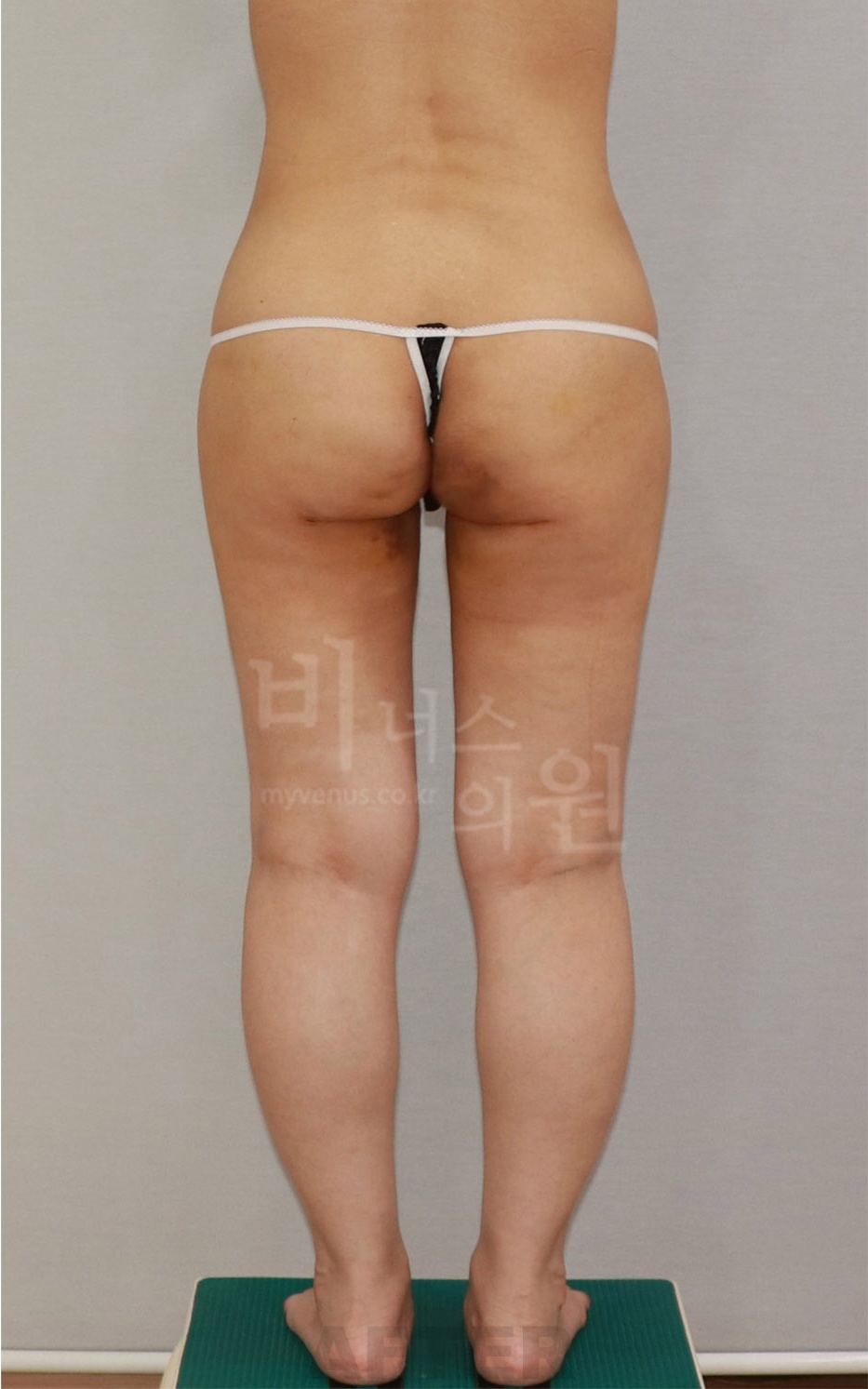 엉덩이 승마살 지방흡입 수술 후 후면1