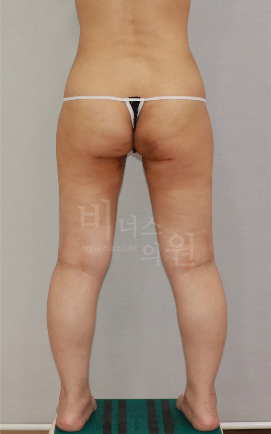 엉덩이 승마살 지방흡입 수술 후 후면2