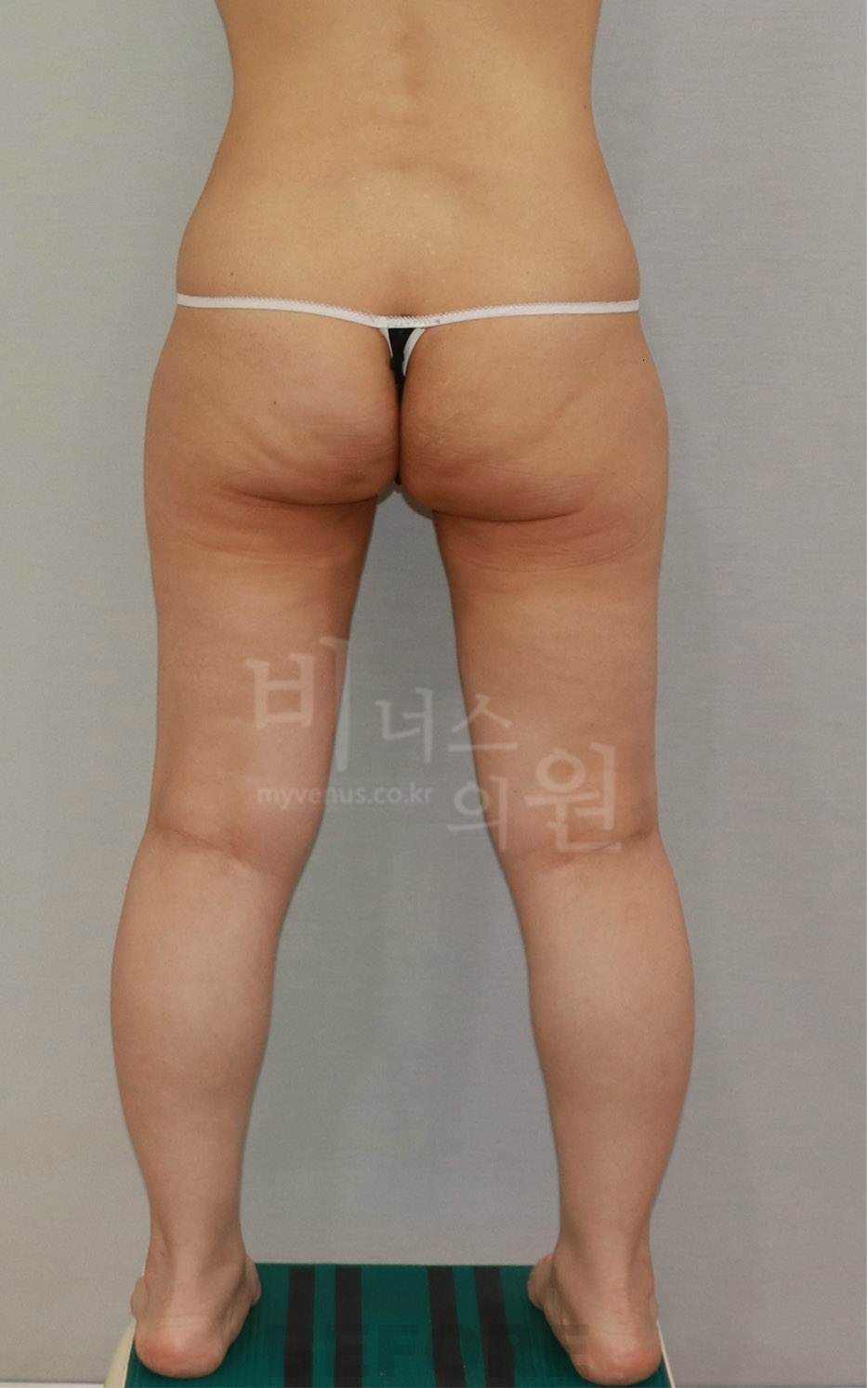 엉덩이 승마살 지방흡입 수술 전 후면2