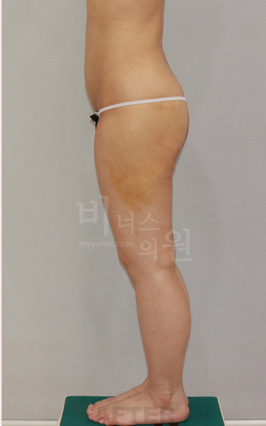 엉덩이 승마살 지방흡입 수술 후 측면1
