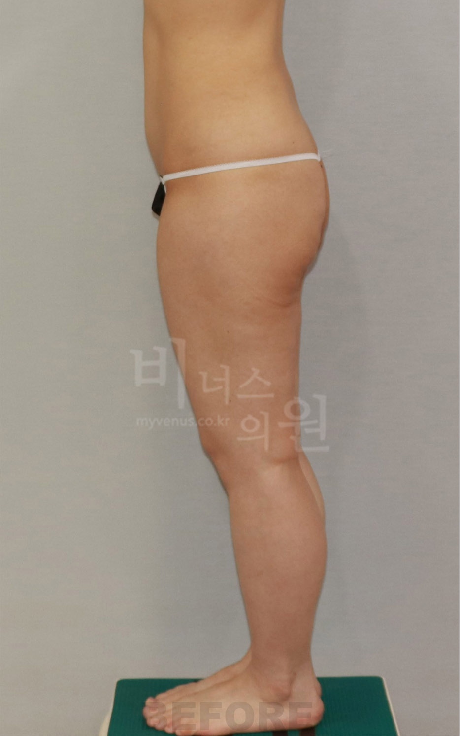 엉덩이 승마살 지방흡입 수술 전 측면1