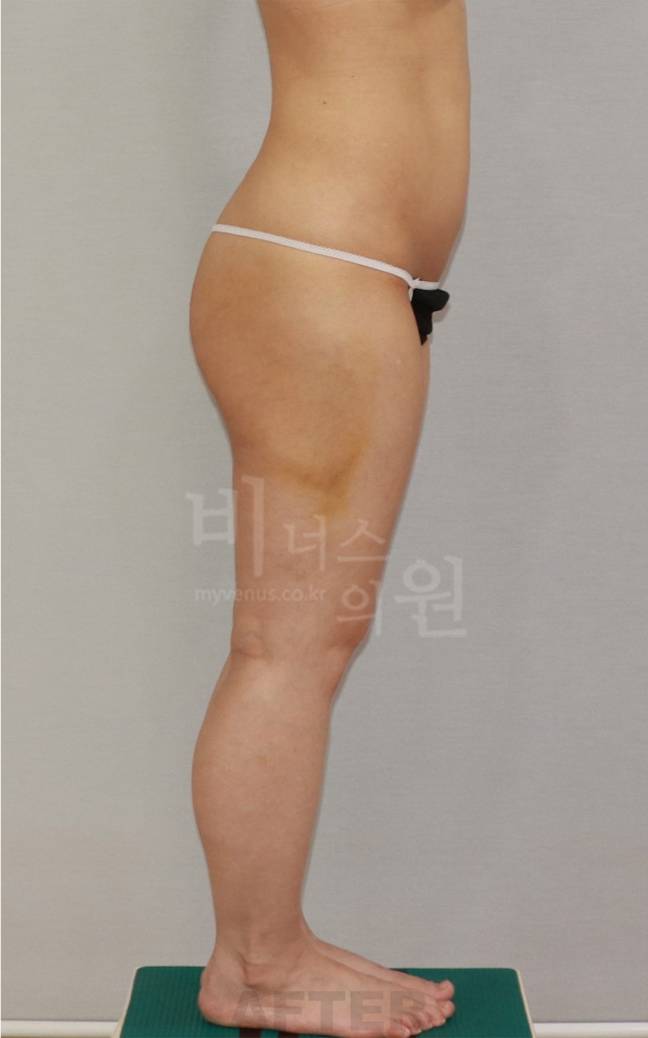 엉덩이 승마살 지방흡입 수술 후 측면2