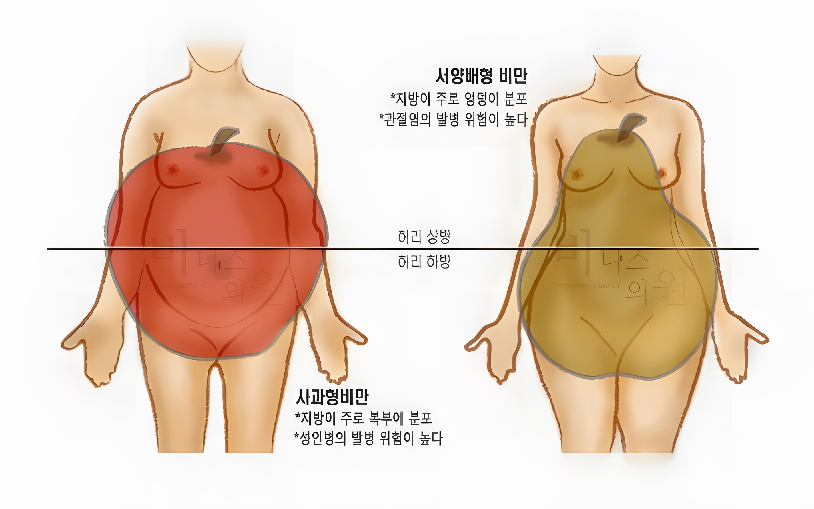 복부 지방흡입 수술 방법 — 투메슨트 마이크로 캐뉼라 정밀 수술