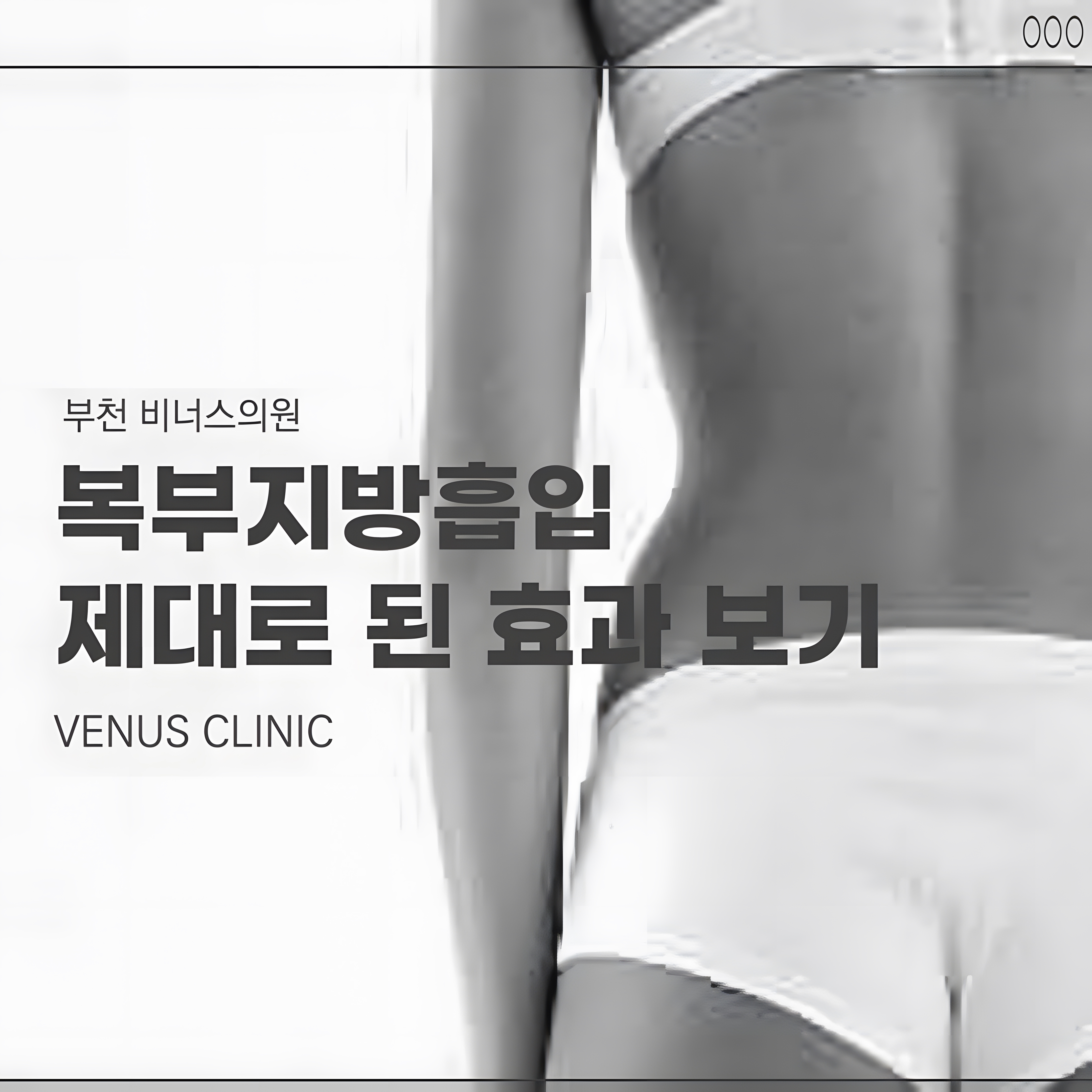 복부 지방흡입 수술 결과 — 원통형 360도 수술로 완성된 바디라인