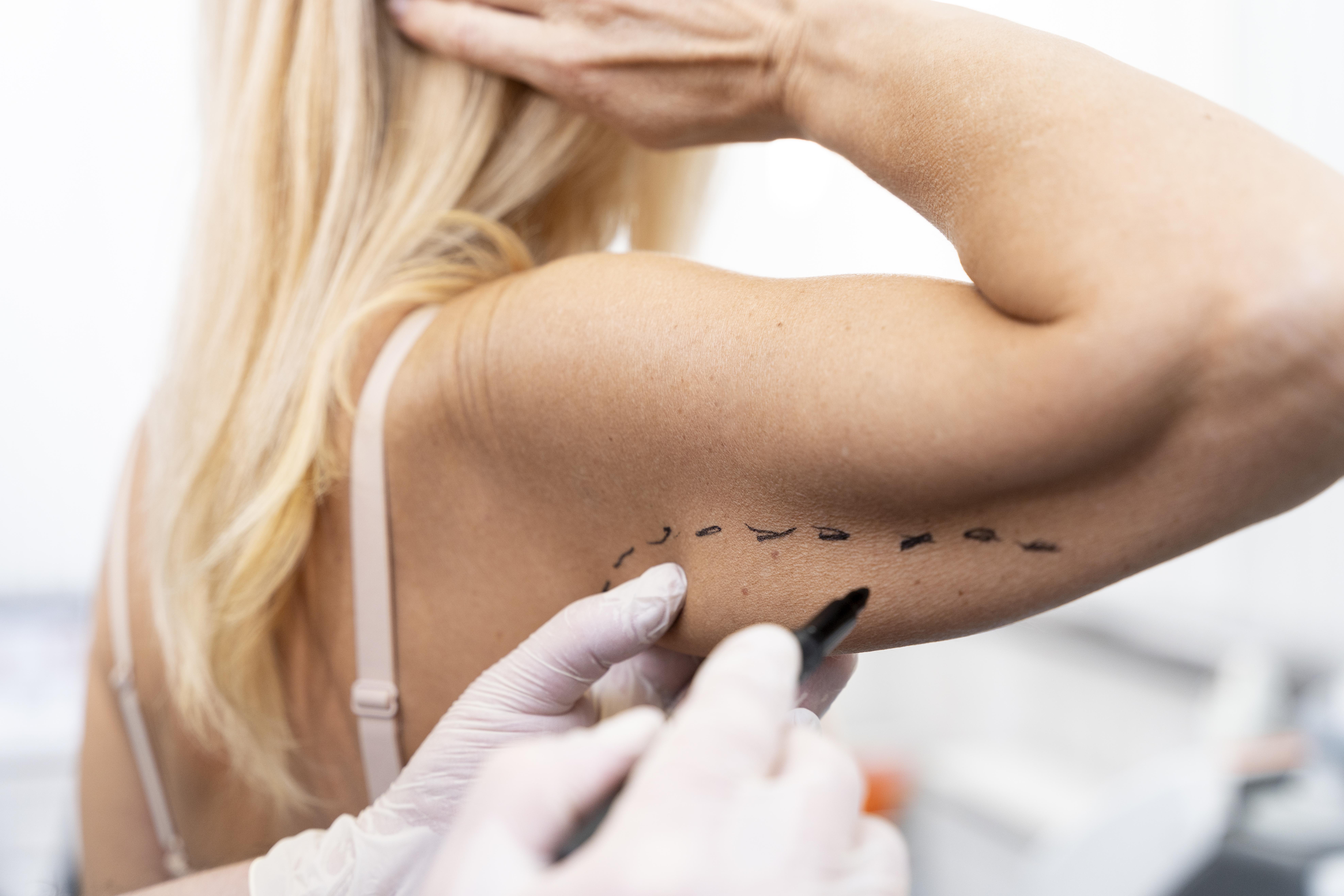 팔뚝지방흡입 수술 전 마킹 — 의사가 팔뚝에 흡입 범위를 디자인하는 과정