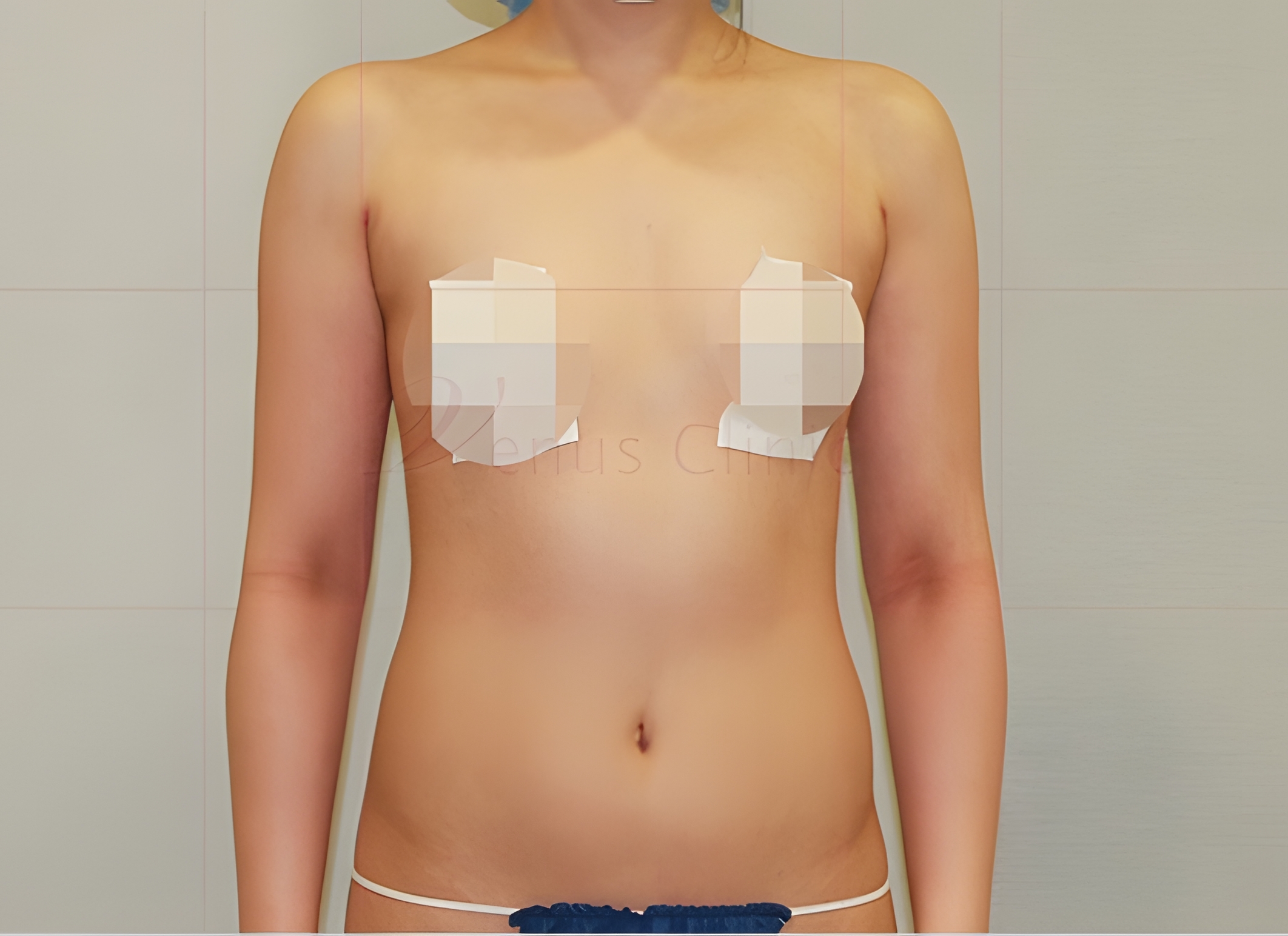 팔뚝지방흡입 후 정면