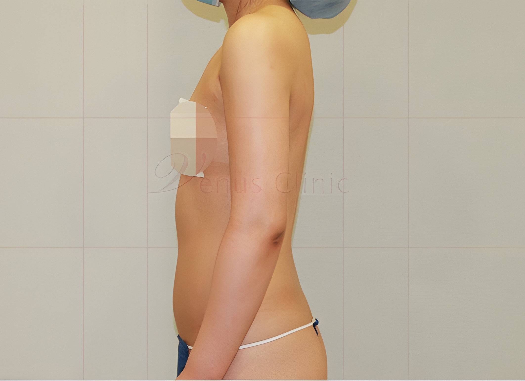 팔뚝지방흡입 후 우측면