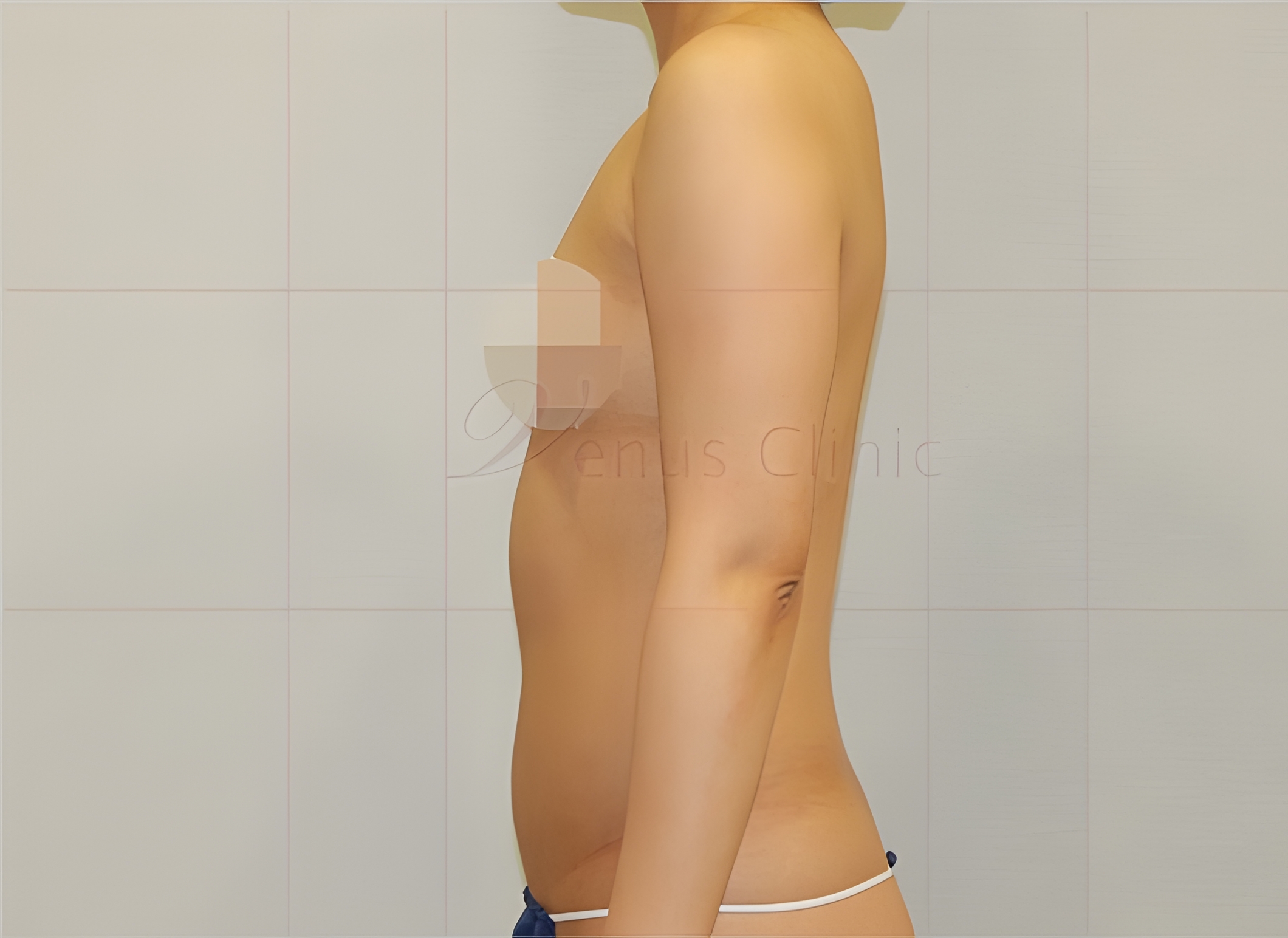 팔뚝지방흡입 전 우측면