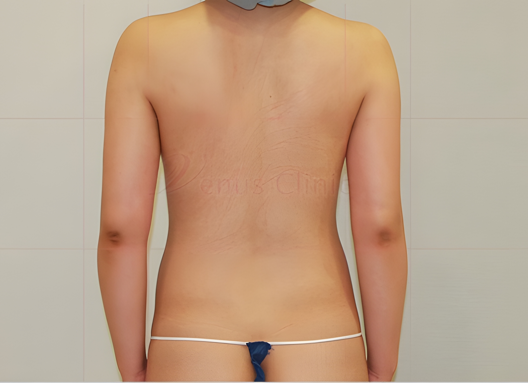 팔뚝지방흡입 후 후면 차렷