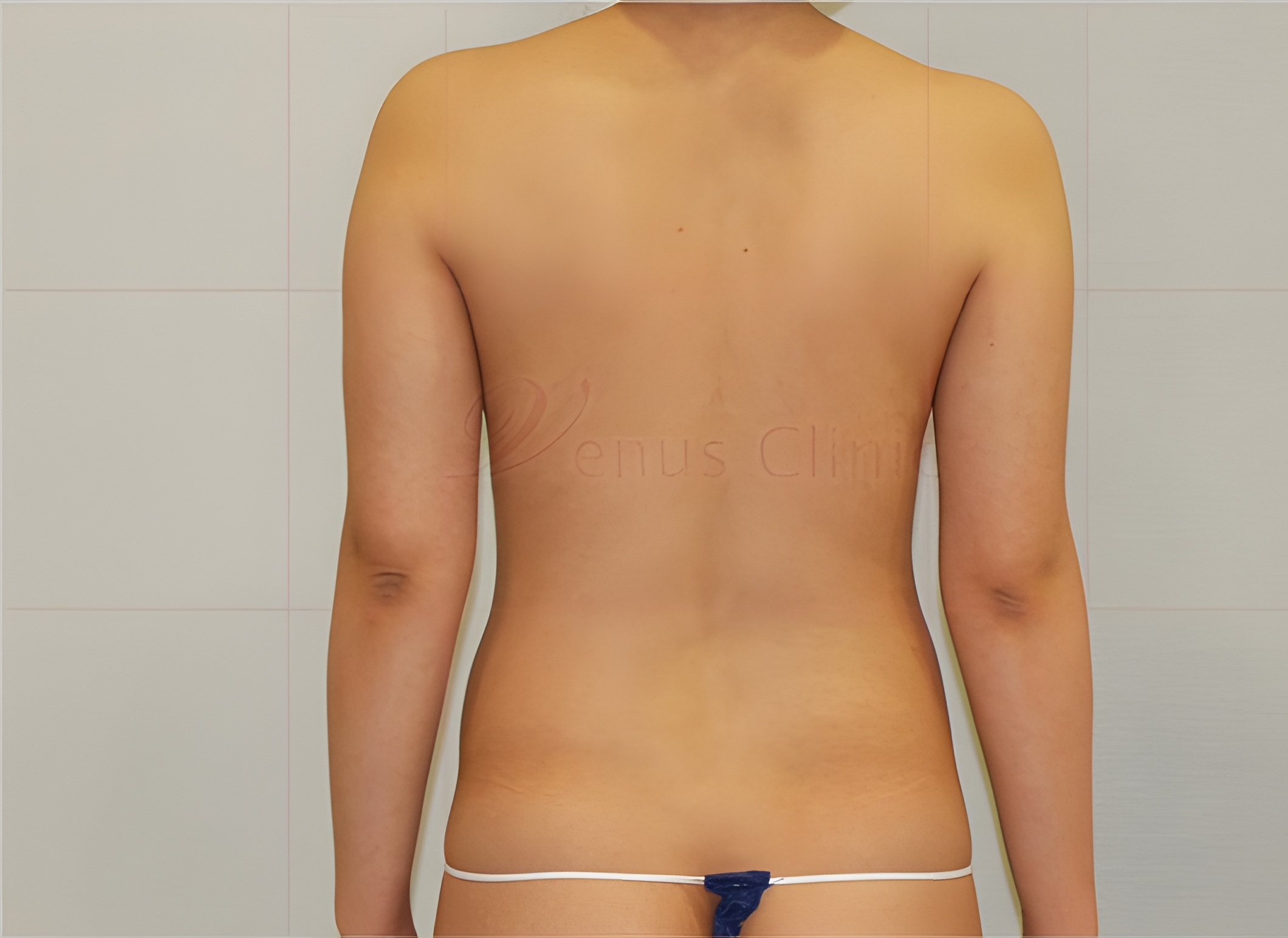 팔뚝지방흡입 전 후면 차렷