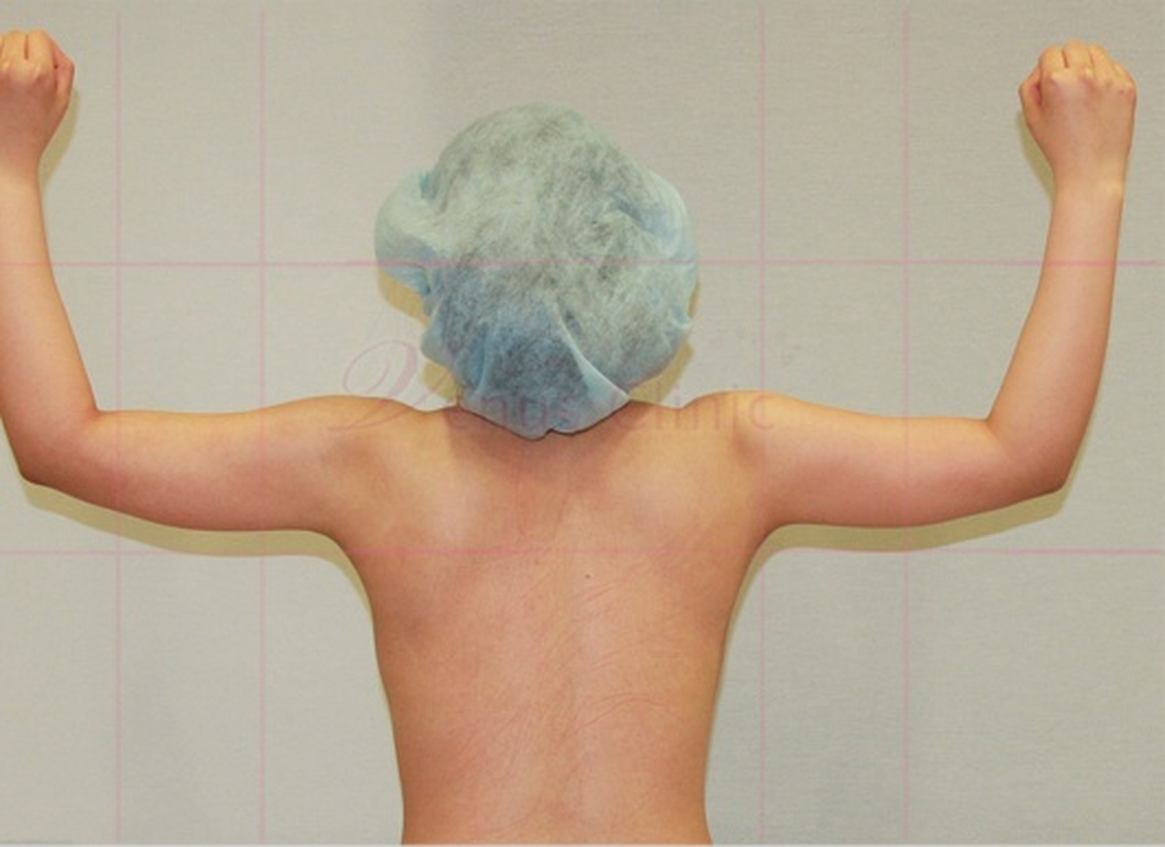 팔뚝지방흡입 후 후면 만세