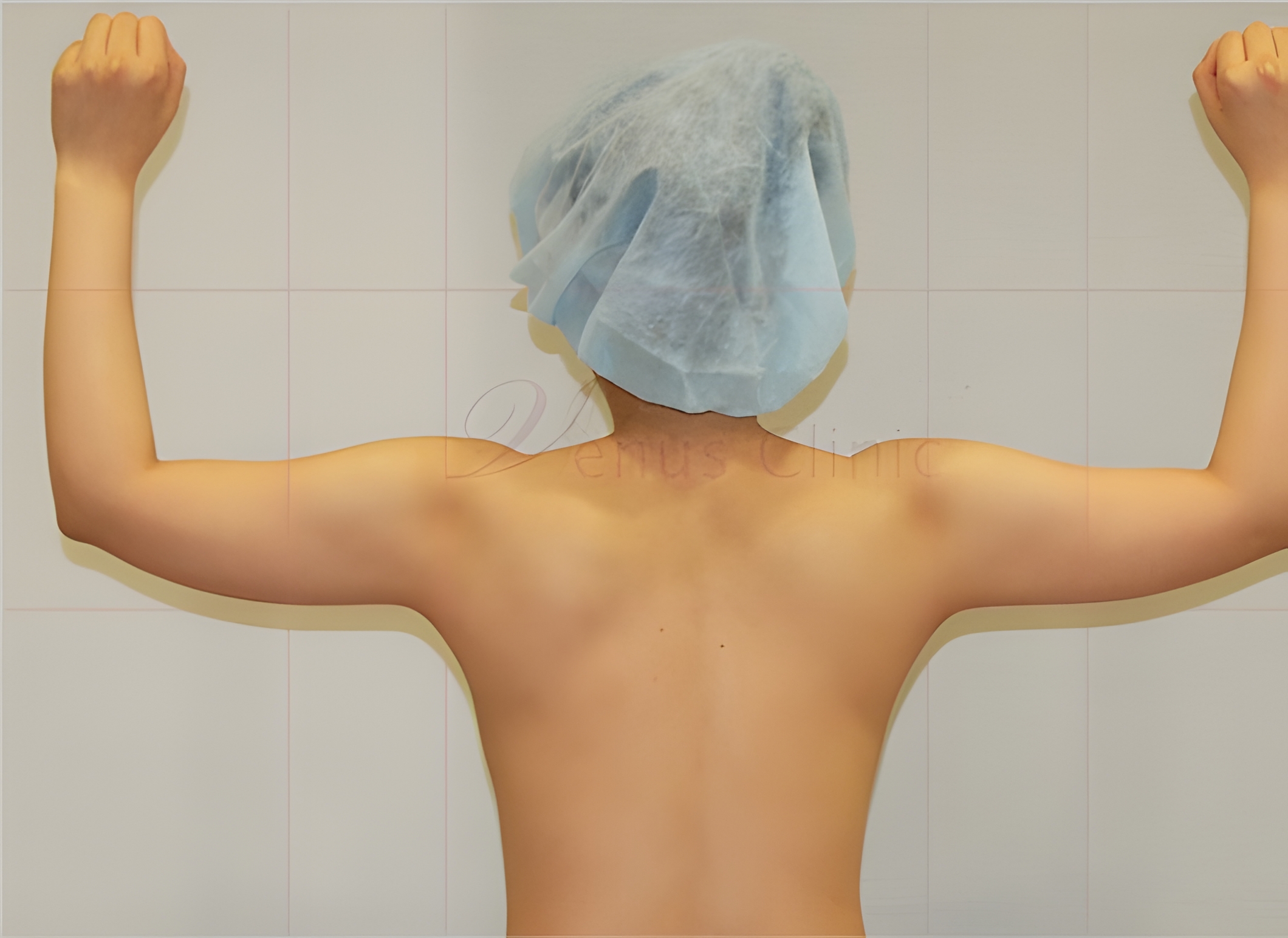 팔뚝지방흡입 전 후면 만세