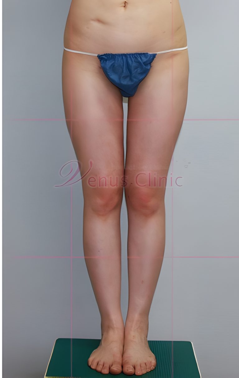 엉덩이 지방흡입 회복 일기 – 압박복 착용부터 일상 복귀까지