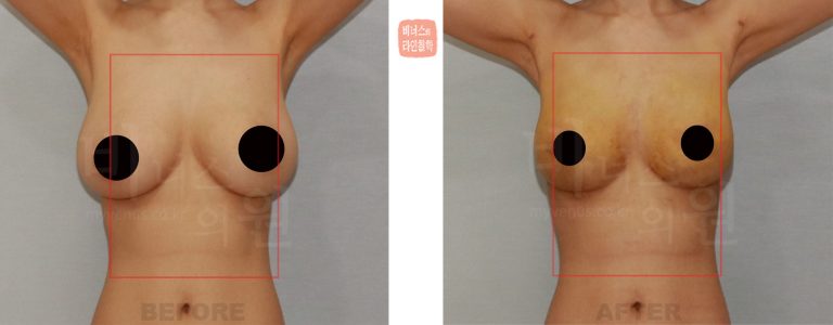 가슴축소 지방흡입, 회복이 이렇게 빠를 줄은 몰랐어요 — 경화과정과 1~4주 회복 흐름 솔직하게