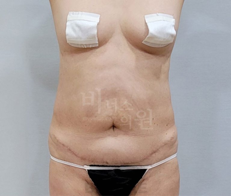 복부지방흡입 병원 선택, 이 5가지는 꼭 확인하세요