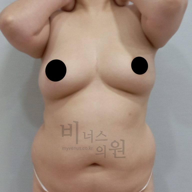 가슴축소수술 후기 — 지방흡입으로 흉터 없이 달라진 6개월 경험 정리
