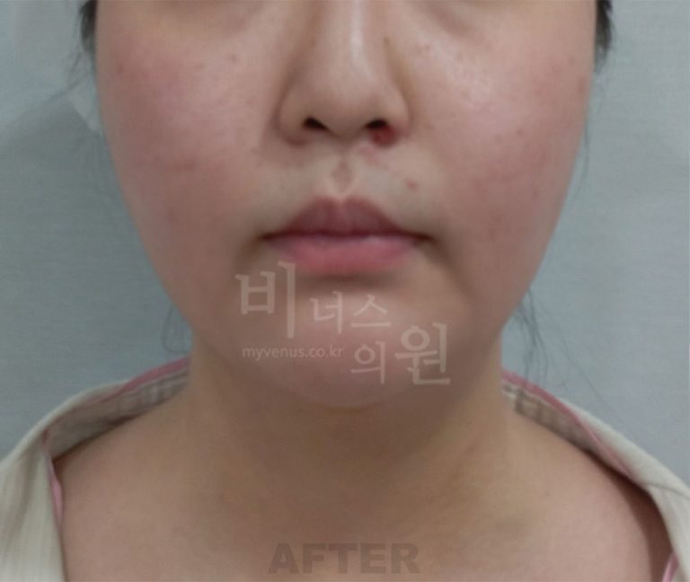 이중턱 지방흡입 회복 후기 — 수술 당일부터 6개월까지 솔직하게