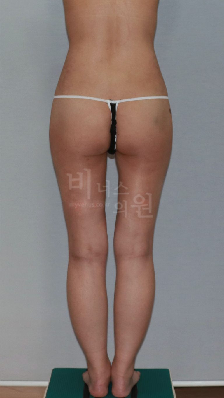 엉덩이축소 지방흡입, 결심부터 3개월까지 — 회복 과정 솔직 정리
