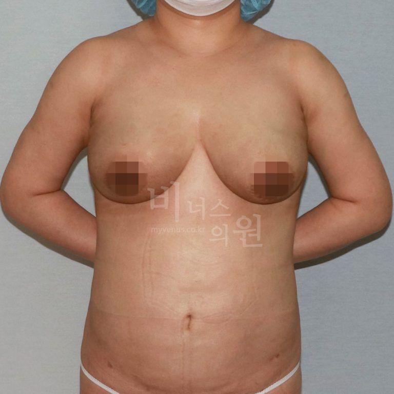 가슴축소수술 회복하면서 알게 된 것들 — 지방흡입 방식의 처짐 개선 원리와 한 달 변화 정리