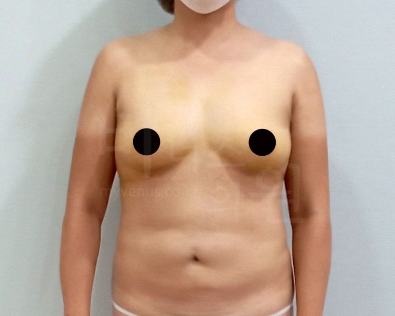 가슴 지방흡입 수술 3일째 직장에 복귀했습니다 — 예상보다 빠른 회복 과정과 4주 일상 기록