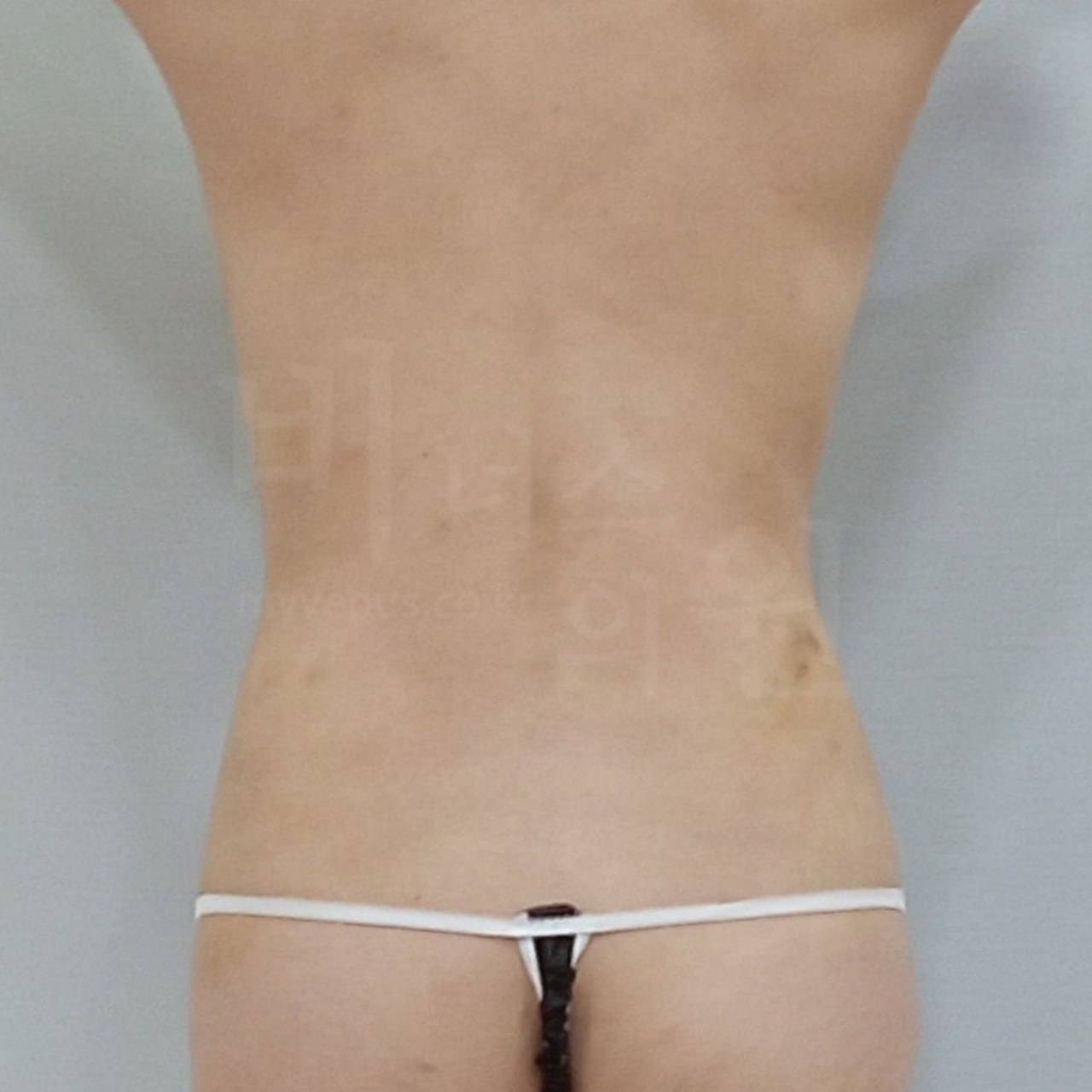 복부 지방흡입 수술 후 후면 — 비너스의원 부천 상동역