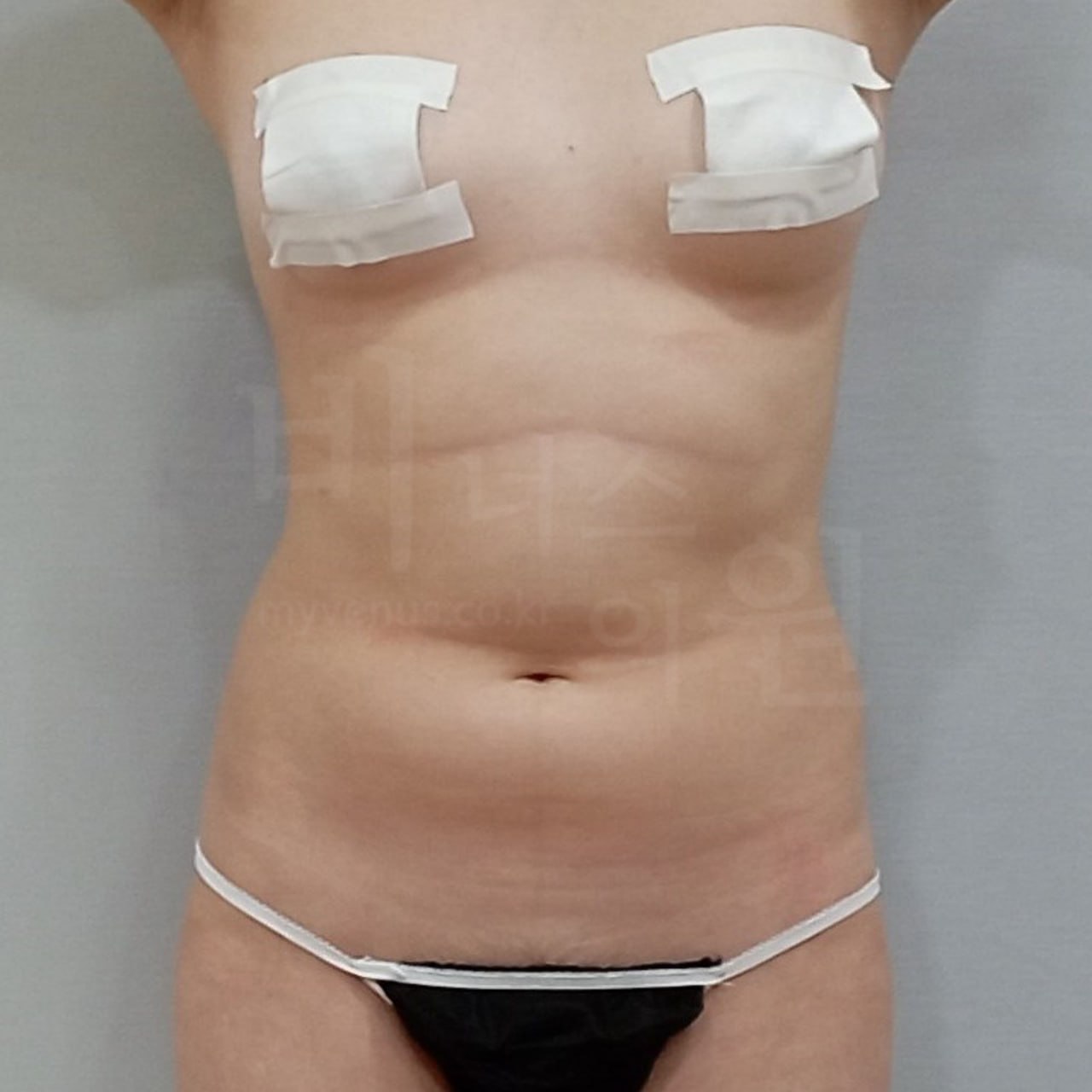 복부 지방흡입 수술 전 정면 — 비너스의원 부천 상동역