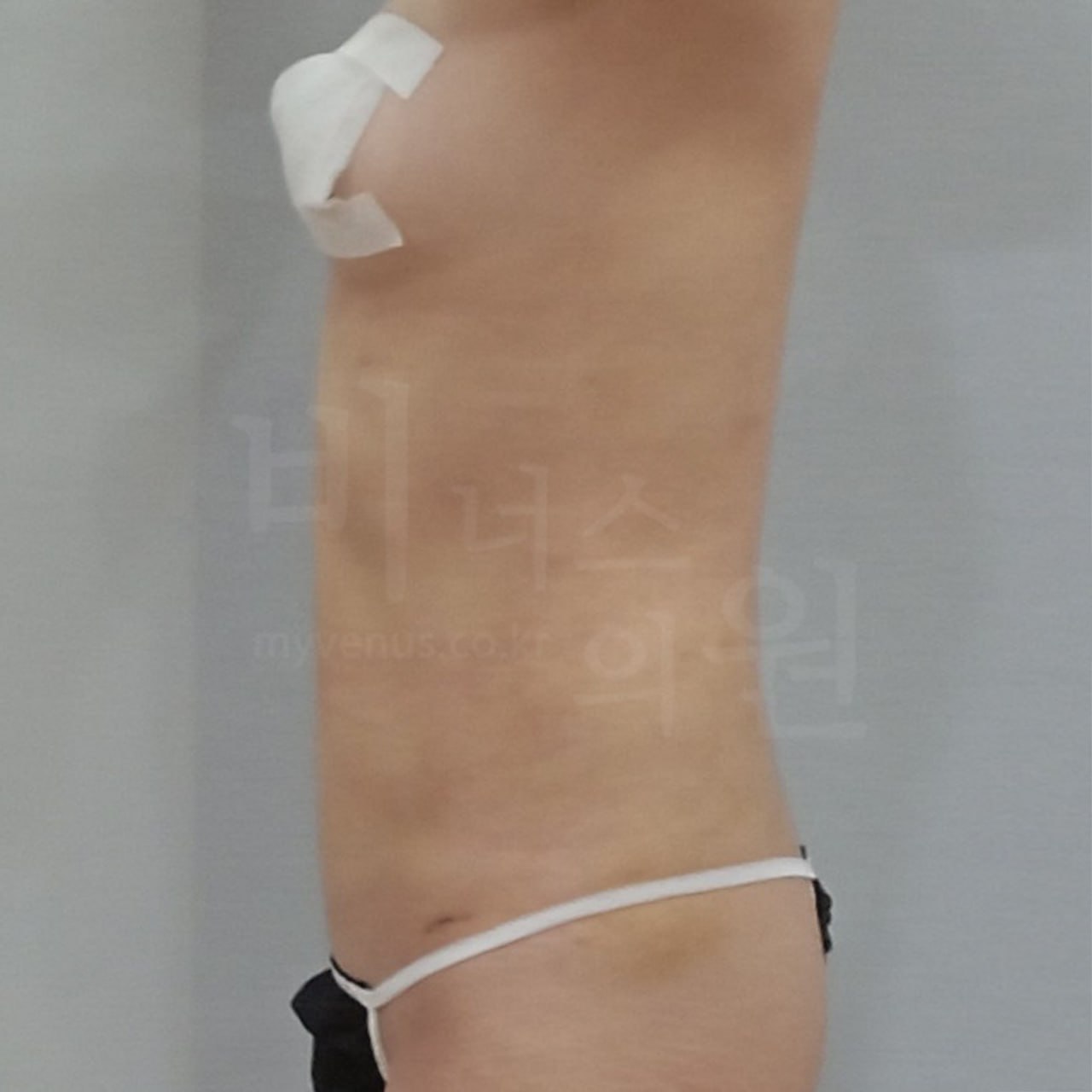 복부 지방흡입 수술 후 측면 — 비너스의원 부천 상동역